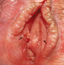 Tiny Itchy Rash On Swollen Labia Minora - HealthTap